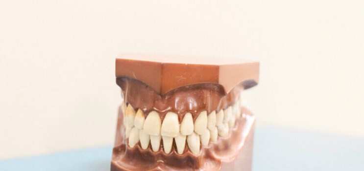 Spiseforstyrrelser kan ødelægge tænderne