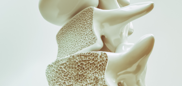 Osteoporose - sådan håndterer du en ny osteoporosediagnose